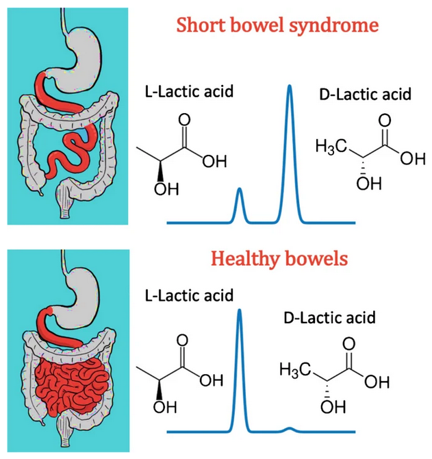 AnalBioanalChem's tweet image. Fast, sensitive LC–MS resolution of α-hydroxy acid #biomarkers via SPP-teicoplanin and an alternative UV detection approach
by Daniel W. Armstrong et al @UTAChemistry @UTAScience @UTArlington #HydroxyAcids #AHAs #enantiomers #spectrometry

link.springer.com/article/10.100…