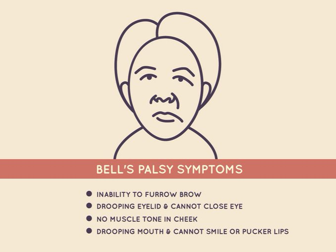 DrImranSheikh's tweet image. Just before her first child was born, this expectant mom learned she had #BellsPalsy. Follow her journey toward recovery: #FacialParalysis #Inflammation
bit.ly/3Lr2pik