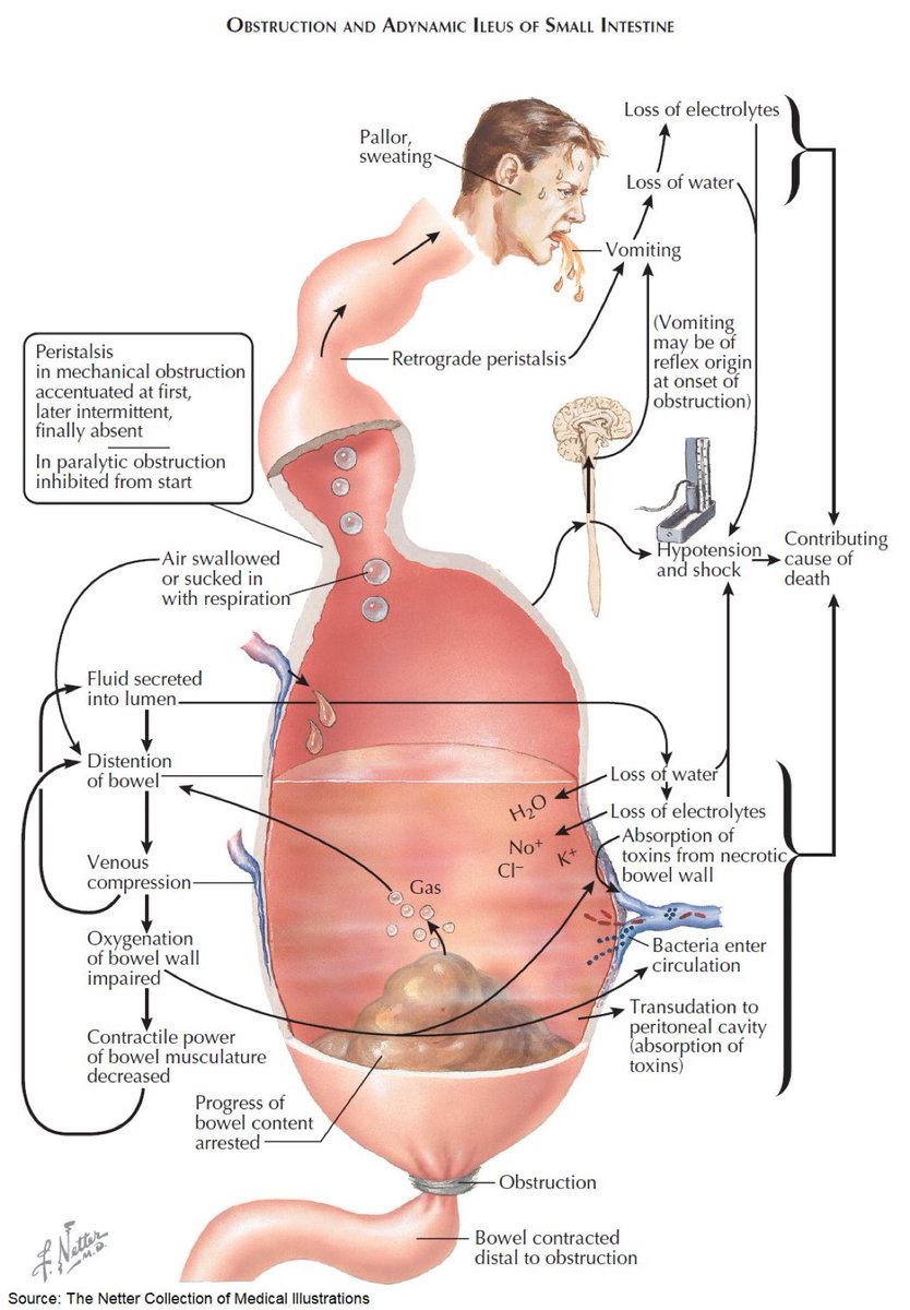 📌 Bowel (Intestinal) Obstruction - Pathophysiology  
#medtwitter #foamed #MedEd #usmle #Surgery #ostomy #stoma