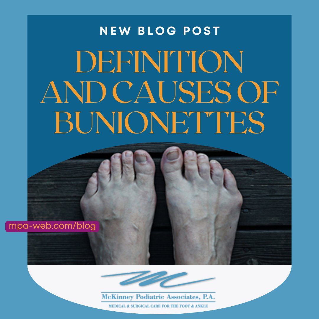 Ever heard of bunionettes?? Follow the link to our blog!
mpa-web.com/blog
.
.
.
#blog #podiatryblog #bunionettes #tailorsbunions #bunions #footpain #footcare #foot #podiatrist #podiatristintexas #texaspodiatry #McKinneyPodiatricAssociates
