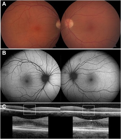 Subfoveal Deposits in Morquio Syndrome
ow.ly/S1cP50R99UN 
#ophthalmology #retina