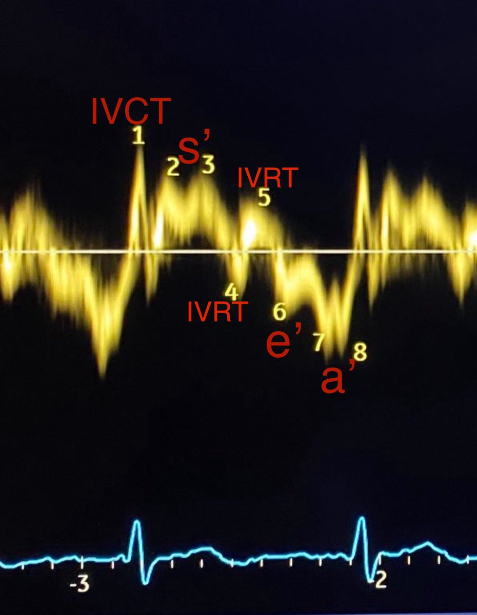 @DrRajeshG1 @CASivaram1 @argulian @purviparwani 1-IVCT 2,3 - s’ which shows a mid systolic septal deceleration likely LVOTO due to HCM 4,5 IVRT(Prolonged from HCM) 6-e’ 7,8 -a’ #EchoFirst