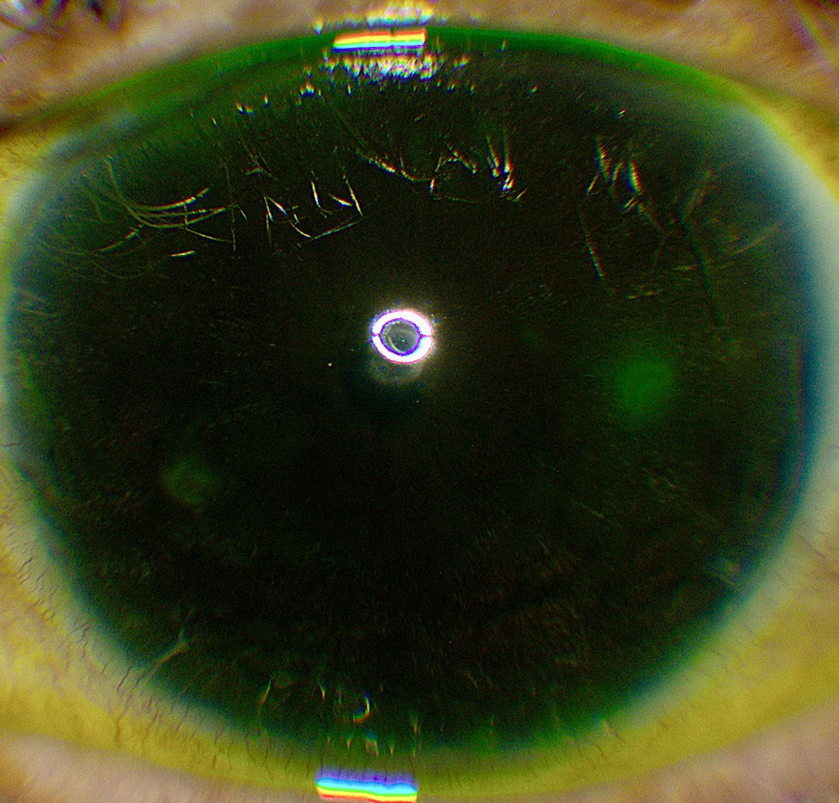 Patient with several small half-moon corneal abrasions, caused by accidentally jamming the eye drop bottle tip into the cornea with glaucoma drop instillation!!!