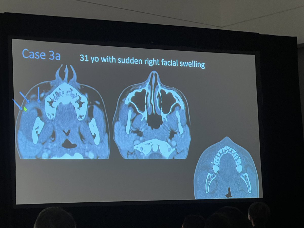 Rapid fire head and neck cases from Dr. Mari Hagiwara #ARRS24