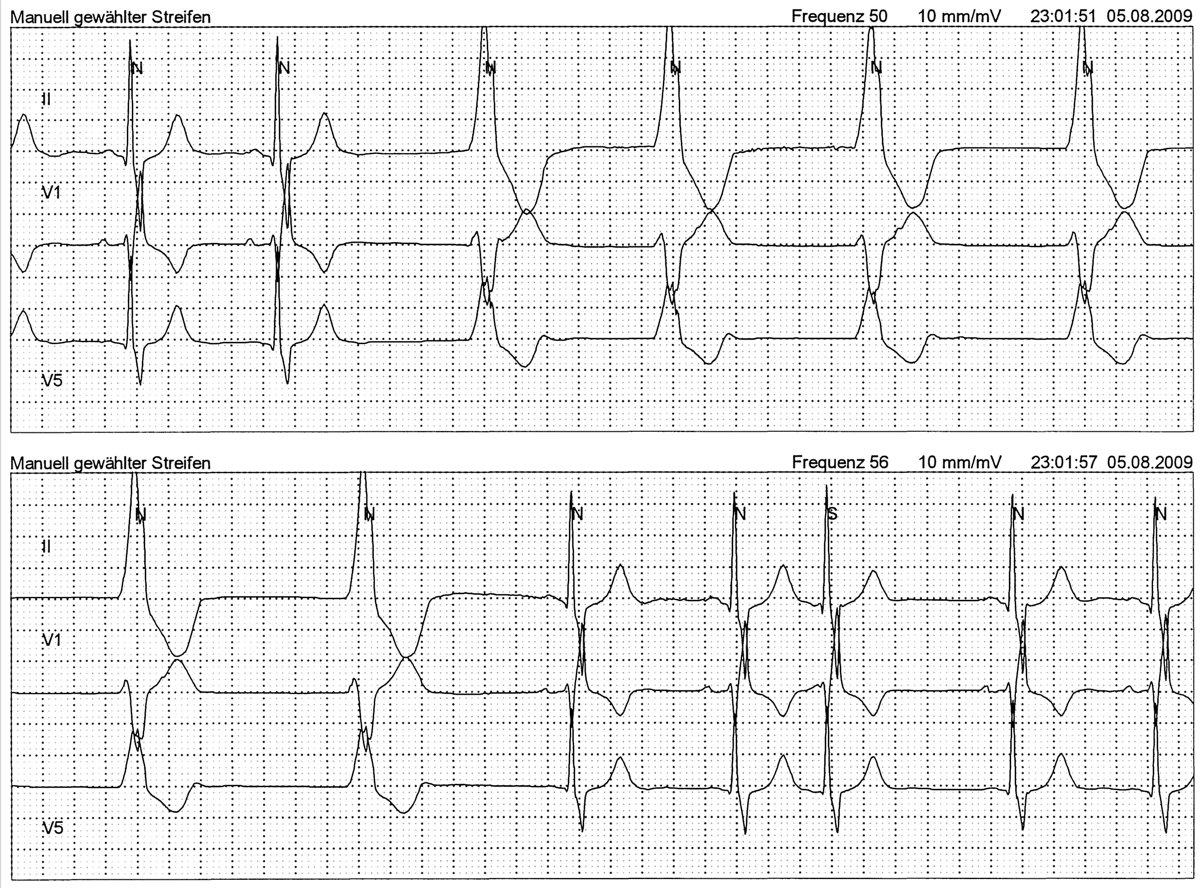 Holter-ECG; 2 continous rhythm strips; what`s your take (easy one!)? 25 mm/s