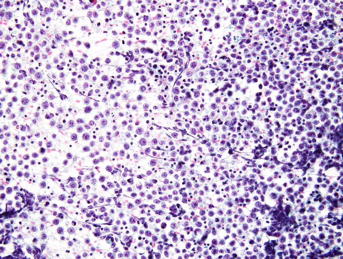 TEXTBOOK example. Retroperitoneal mass in a man in his 30s - “Seminoma”. (FNA, Pap stain)