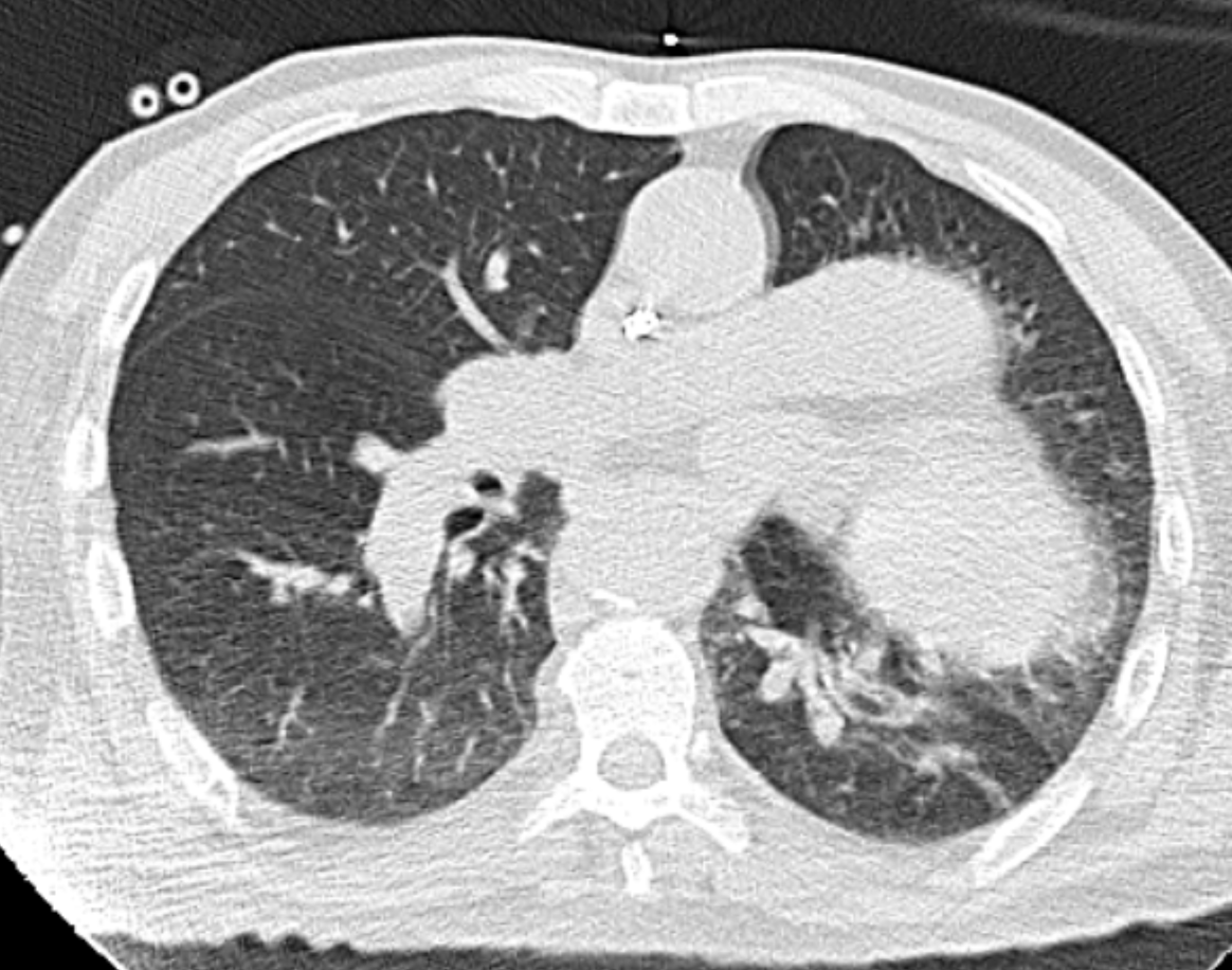 Case of the day, first time for me. Unfortunately I don't have an x-ray but it's a good one to teach residents though @DanielVargasMD @JordiBroncano @howardm19 @TLHM_MD @Ivanvollmert #Radiology #chestrad