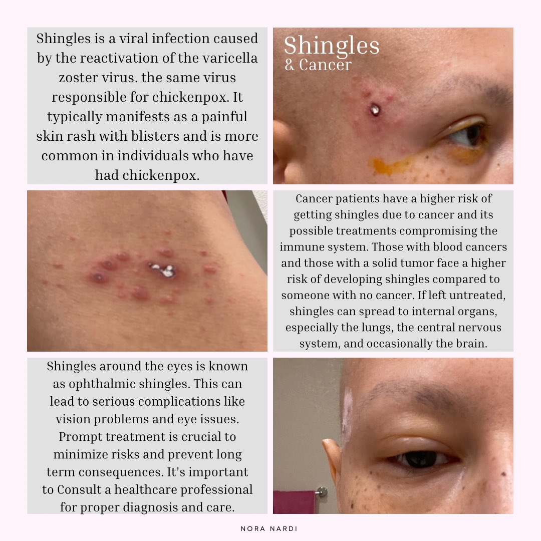 These are a few pictures of me with shingles and some helpful information that I would’ve liked to have known while fighting cancer. Did you or someone you know get shingles while fighting cancer? 

#shingles #ophthalmic #cancer #nonhodgkinslymphoma #cancercommunity