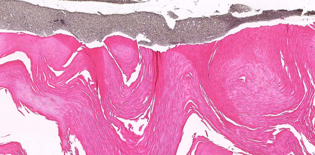 Can you figure out...Site/specimen type? Diagnosis? Fun bonus finding? WSI digital slide: kikoxp.com/posts/1930. Stains: kikoxp.com/posts/10167. Answer & video: kikoxp.com/posts/3966 #pathology #pathologists #pathTwitter #dermpath #dermatology #dermatologia #dermtwitter