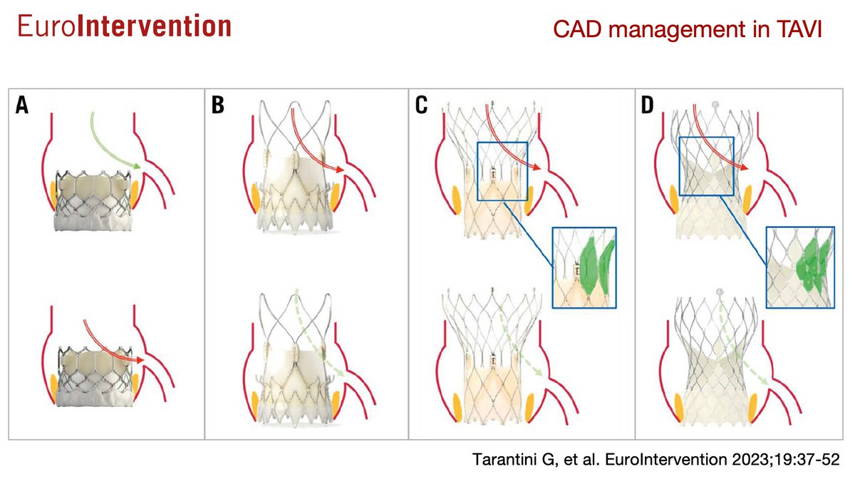 ACI-SEC: Hemodinamica (@shci_sec) on Twitter photo Manejo de la enfermedad coronaria en pacientes con TAVI. Una revisión bastante completa by <a href="/EuroInterventio/">EuroIntervention</a>
eurointervention.pcronline.com/article/manage… Manejo de la enfermedad coronaria en pacientes con TAVI. Una revisión bastante completa by <a href="/EuroInterventio/">EuroIntervention</a>
eurointervention.pcronline.com/article/manage…
