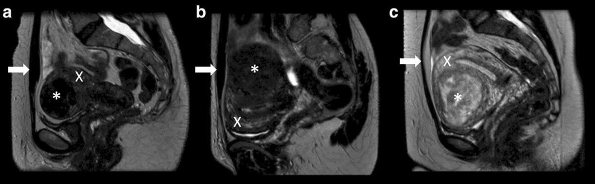 This study assessed the learning-curve during the implementation of the Magnetic Resonance image-guided High-Intensity Focused Ultrasound (MR-#HIFU) treatment of uterine fibroids in the authors' center. (K.J. Anneveldt et al.)

#InsightsIntoImaging

🔗 buff.ly/4aXzn7i
