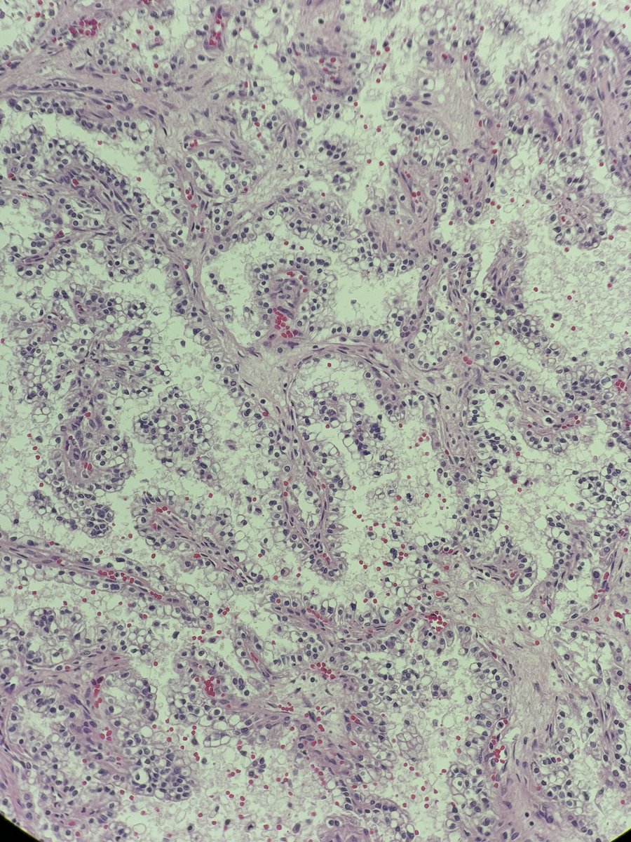 An incidental finding in an adult autopsy. #pathology #renalpathology
