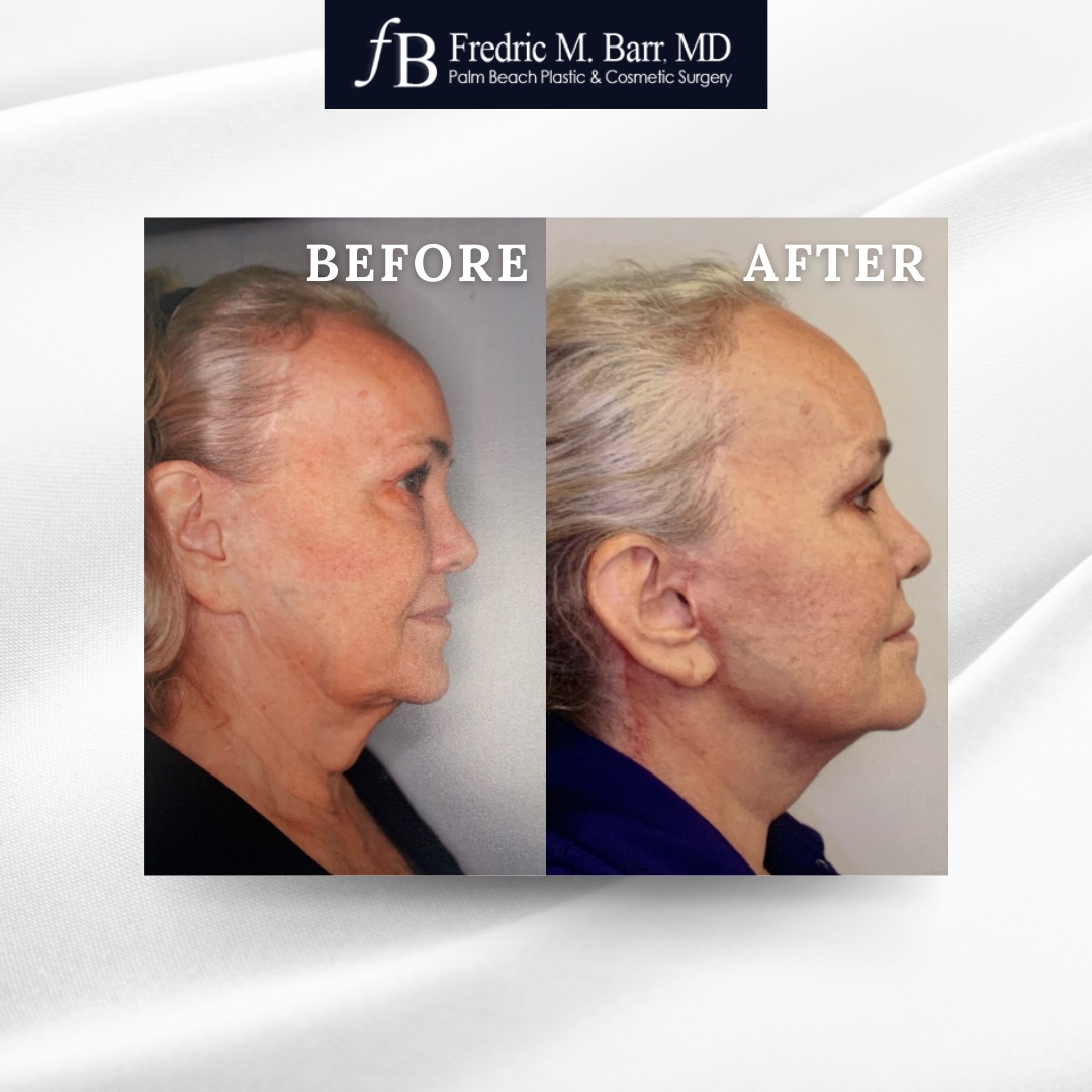 It's #TransformationTuesday!✨

Before and after photos of a Neck Lift. 

📲 Call (561) 559-7236

#PalmBeachPlasticAndCosmeticSurgery #beforeandafter #PalmBeach #transformation #DoctorPalmBeach #necklift #cosmeticsurgery #plasticsurgery #plasticsurgeon