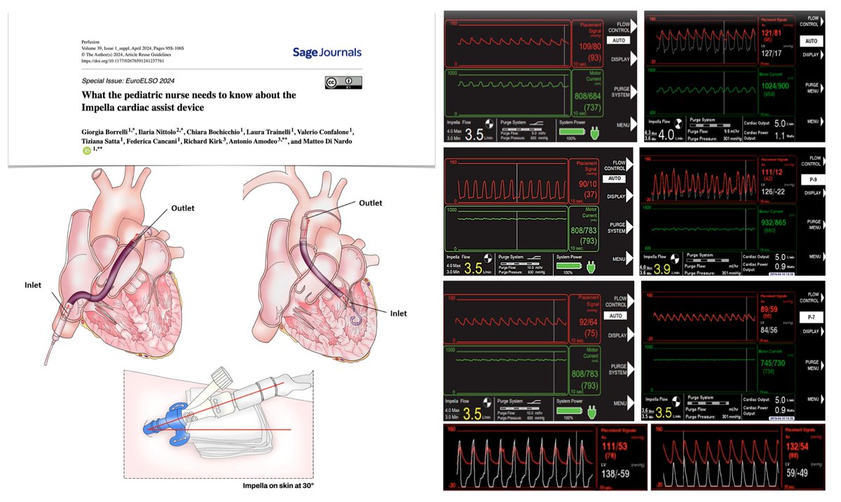 What pediatric nurse needs to know about #Impella
⚙️ micro-axial pump
🧸pediatric anthropomorphic & anatomic factors to determine candidacy 
🔍 how to check position, what to look at bedside & how to assess/change access site dressing
🩸anticoagulation management 
⚠️ associated…