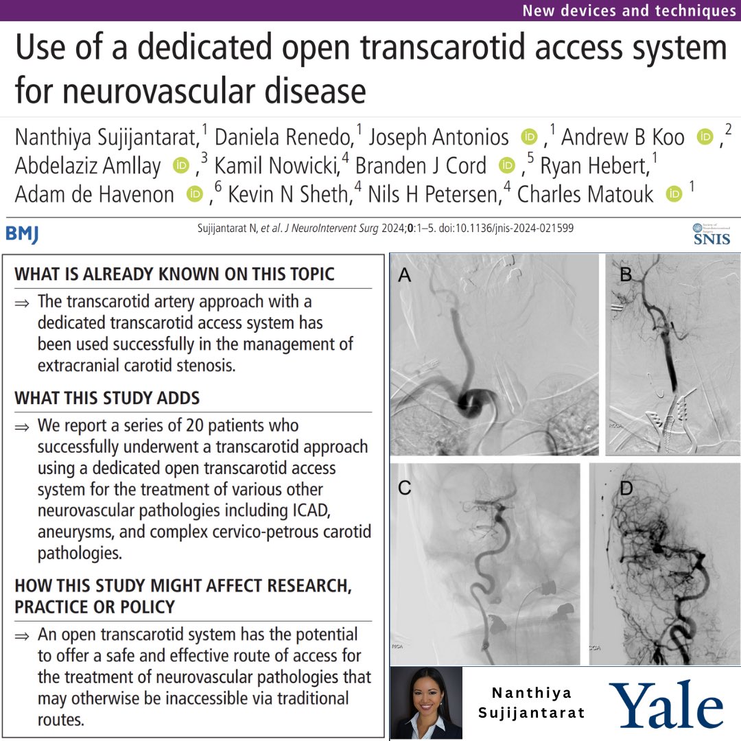 When access is difficult or there is a desire to use a neuroprotection strategy for intracranial neurovascular procedures, we have found off-label use of Silk Road Medical's Open Transcarotid System to be invaluable.  Check out our Yale experience!