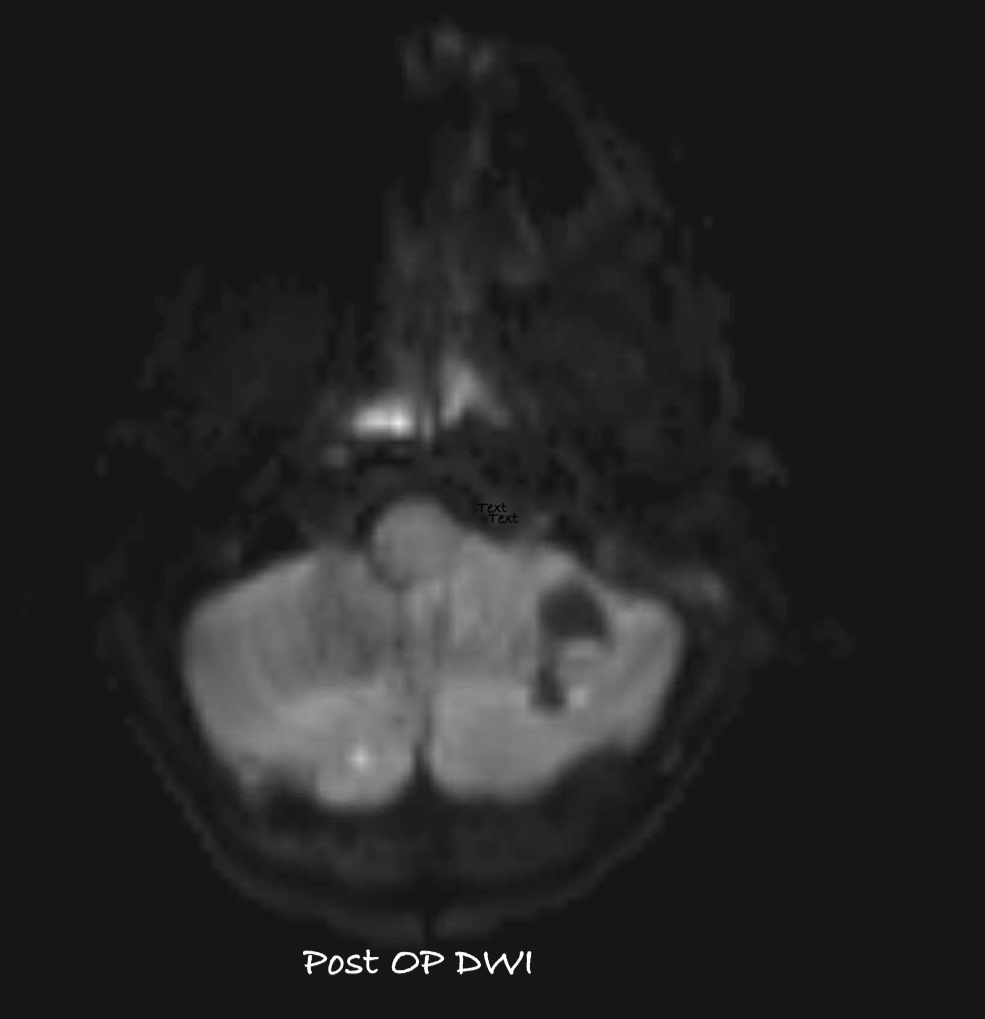 6F with one week h/o otitis, tx by PCP. Came to ED with lethargy, ataxia, vomiting. Imaging showed p fossa cystic lesion with hydrocephalus. Emergent EVD placement, suboccip craniotomy with abscess washout followed by mastoidectomy. #MedTwitter #neuro #neurosurgery #neurotwitter