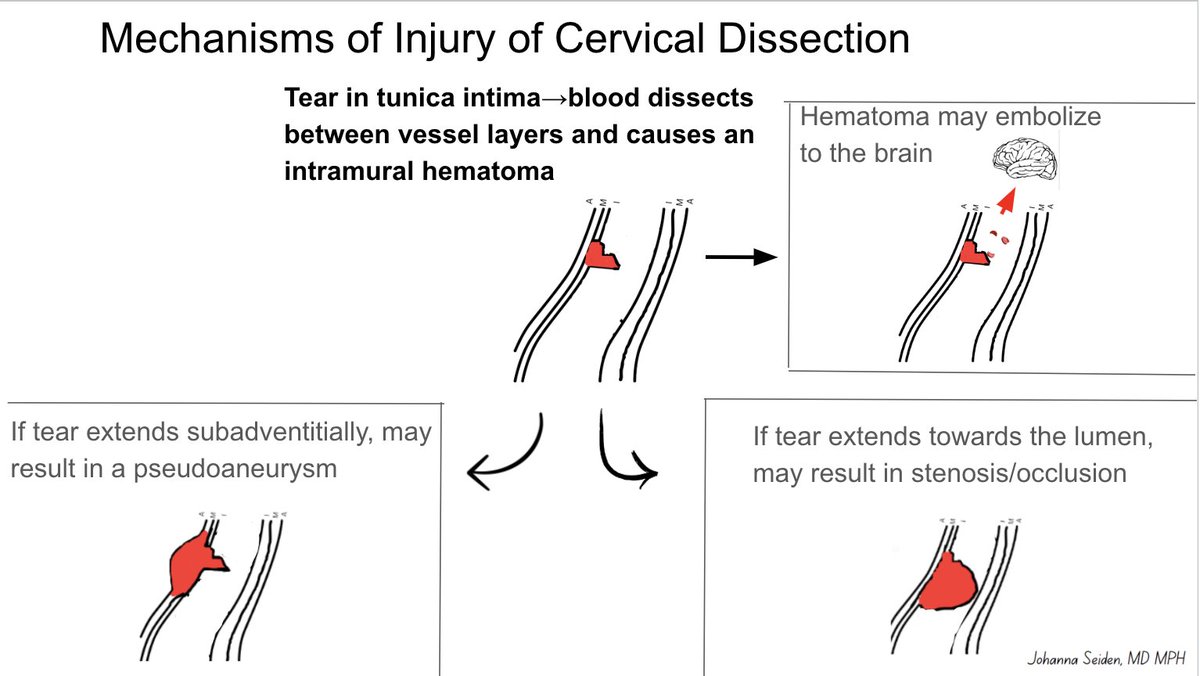 Illustration of mechanisms of injury of Cervical Dissection #stroke #strokemed #MedEd #neurotwitter  #neurology