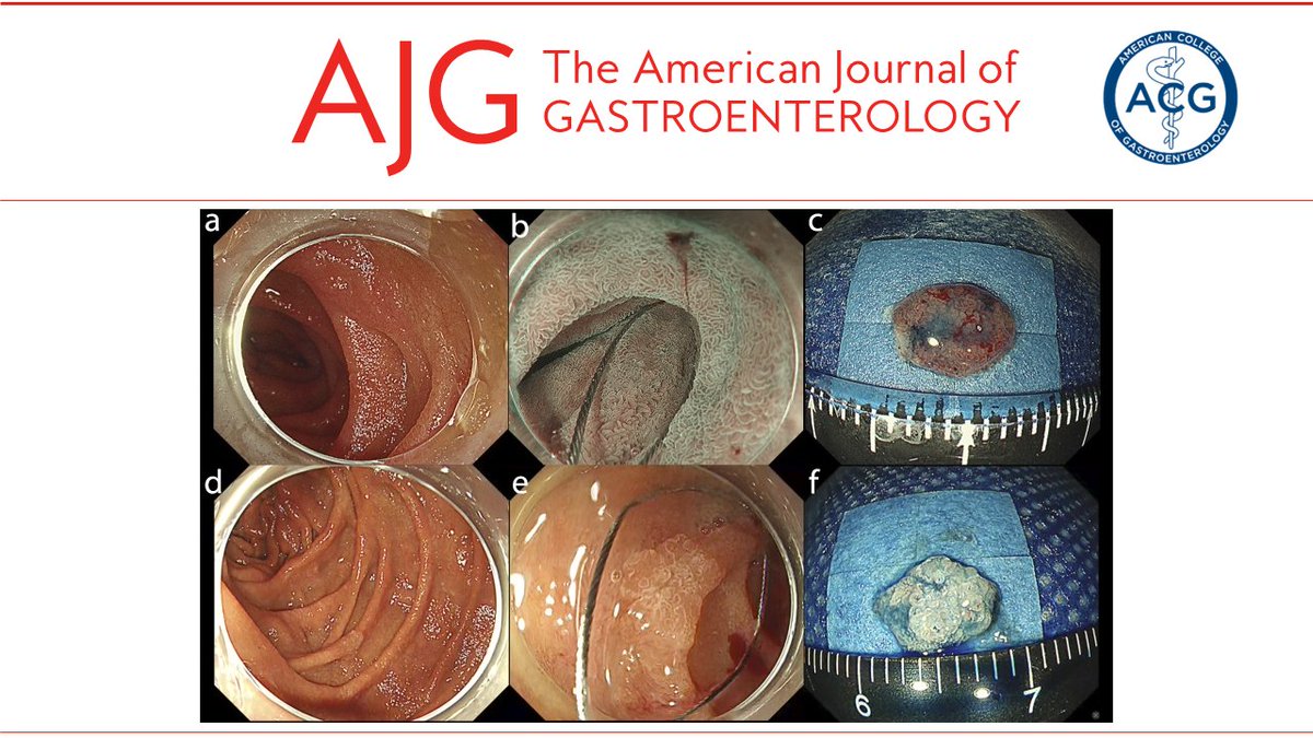 In the 📕#RedJournal: Resectability of Small Duodenal Tumors: A Randomized Controlled Trial Comparing Underwater Endoscopic Mucosal Resection and Cold Snare Polypectomy Miyazaki, et al. 👉 bit.ly/3wg1WxH @MLongMD @JasmohanBajaj