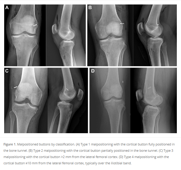 Do you really know where your button is? This study from @TAMC showed button malposition in 3.5% of ACLR and encourages the use of fluoroscopy or direct visualization to decrease incidence. #ACLR #kneearthroscopy See the study here! ow.ly/JQ3n50Rjphj