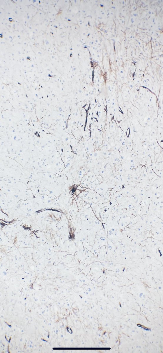 Ganglioglioma is biphasic with neuronal and glial components, usually with eosinophilic granular bodies, perivascular inflammation, and CD34+ ramified elements (IHC below is CD34). Absence of CDKN2A homozygous deletion helps distinguish from PXA #neuropath #cytopath