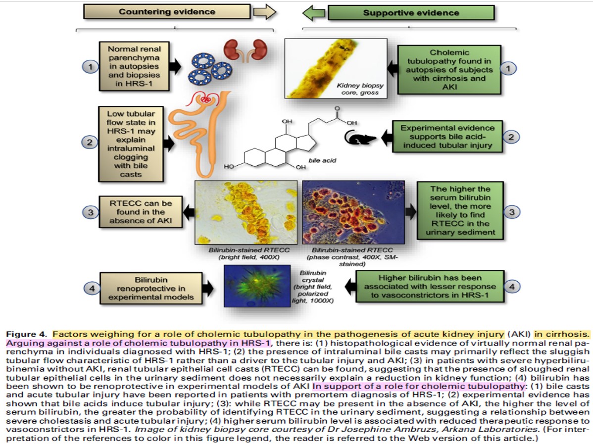 #Nephpearls #MedTwitter #MedEd
Sx Hepatorenal - tipo 1 🧐

🔸Esquema de fisiopatología 👀✍🏼🔝
🔸Además de lo hemodinámico como causa, considerar el aporte al daño, de la congestión venosa e injuria renal directa
🔸Controversial la nefropatía colémica 👀👇🏼

Vélez et al. AKDH. 2024