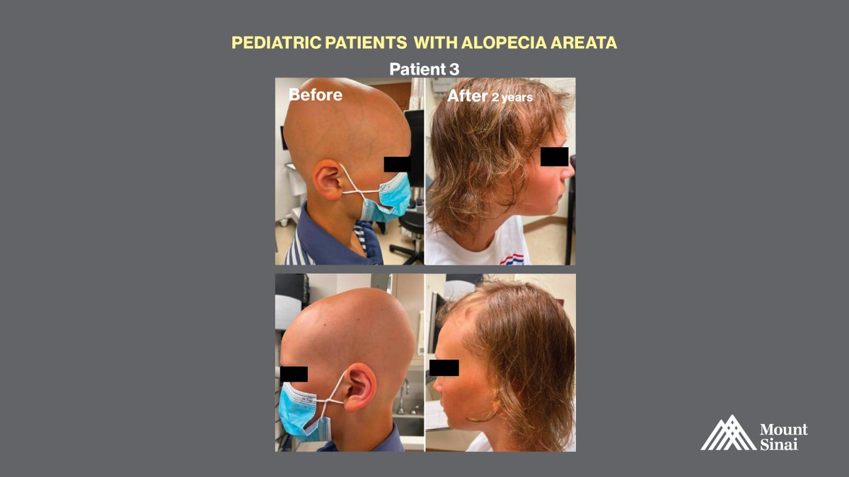 Pediatric patients with severe cases have great outcomes through new treatments, making #happypatients under the expert care of @EmmaGuttman & the team at Alopecia Center of Excellence #WeFindAWay #alopeciaareata #alopecia #beforeandafter #hairgrowth @IcahnMountSinai