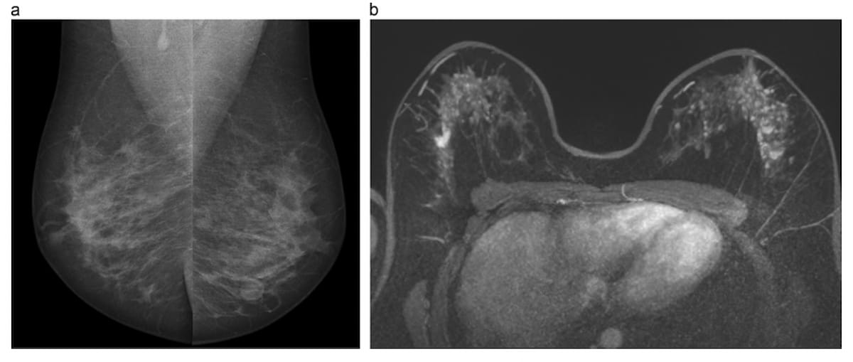 European Society of #BreastImaging Issues Updated #BreastCancer Screening Recommendations 
diagnosticimaging.com/view/european-…
@ACRRFS @ACRYPS @RadiologyACR @ARRS_Radiology @RSNA @BreastImaging @SBIRFS @EUSOBIyc @RadiologyUSC @UWRadiology @UCSFimaging @OHSURadiology 
#radiology #RadRes