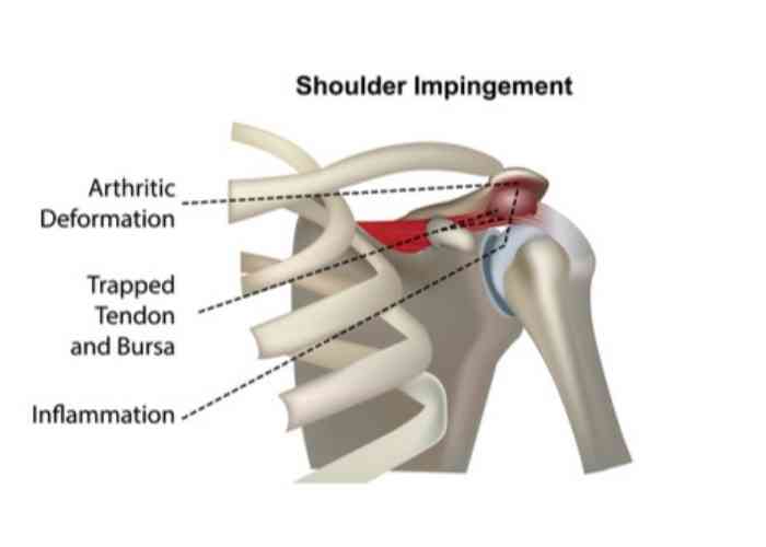 Noticing #shoulderpain interfering with your daily activities? It could be #shoulder #impingement. Recognize the symptoms:
· Dull ache near the collarbone
· Sharp pain with reaching overhead
· Weakness and loss of motion. Don't let it hold you back! 
medilink.us/5ngw