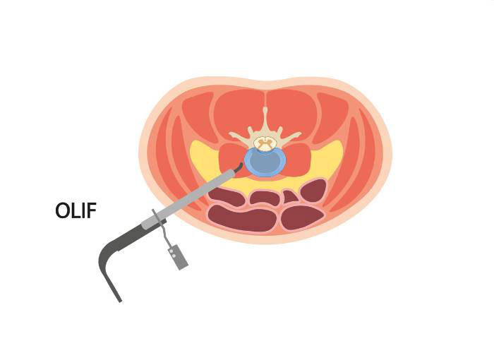 Say goodbye to #backpain with #LLIF! Dr. Pennicooke specializes in this minimally invasive procedure to bring relief to patients in St. Louis & beyond. Learn more about how LLIF can help you reclaim your life from discomfort & nerve compression.medilink.us/cbla  #spinecare