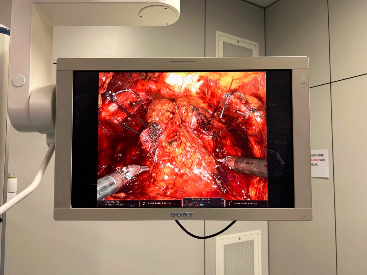 Véronique Phé (@pheveronique) on Twitter photo 🔥Revival of Burch colposuspension
🤖A traditional old good technique performed with modern technology
🎯Still need to define a standardised curriculum for young urologists
👉This is <a href="/sonnyurol/">Arun Sahai</a>’s mission for the <a href="/UrowebESU/">European School of Urology (EAU ESU)</a> functional urology working group <a href="/Uroweb/">European Association of Urology (EAU)</a> <a href="/icsoffice/">ICS</a> 🔥Revival of Burch colposuspension
🤖A traditional old good technique performed with modern technology
🎯Still need to define a standardised curriculum for young urologists
👉This is <a href="/sonnyurol/">Arun Sahai</a>’s mission for the <a href="/UrowebESU/">European School of Urology (EAU ESU)</a> functional urology working group <a href="/Uroweb/">European Association of Urology (EAU)</a> <a href="/icsoffice/">ICS</a>
