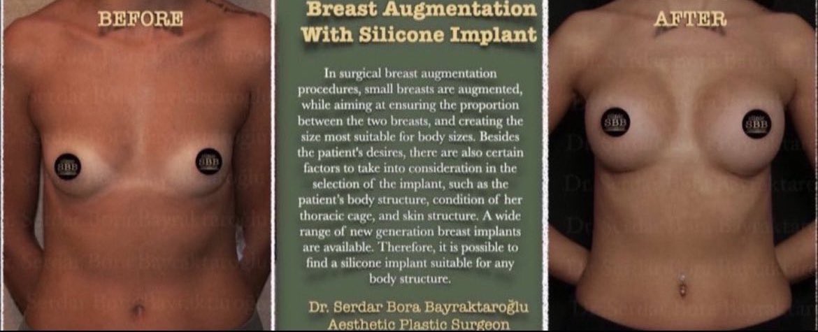 BREAST AUGMENTATION/ WITH SILICONE IMPLANT

With a silicone breast implant, you can have a more natural, athletic and feminine appearance.

 #clinicsbbinternational #aestheticsurgery #plasticsurgery  #plasticsurgeon #clinicsbb #beforeafter #silicone #implant #breastaugmentation