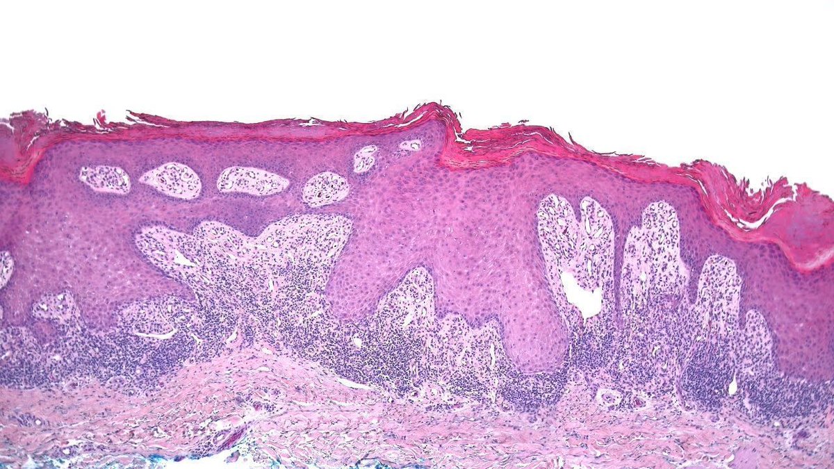 Adult with multiple thick plaques on lower legs. Your diagnosis? Answer: youtu.be/4auJD2iETHo?si…. #pathology #pathologists #pathTwitter #dermpath #dermatology #dermatologia #dermtwitter