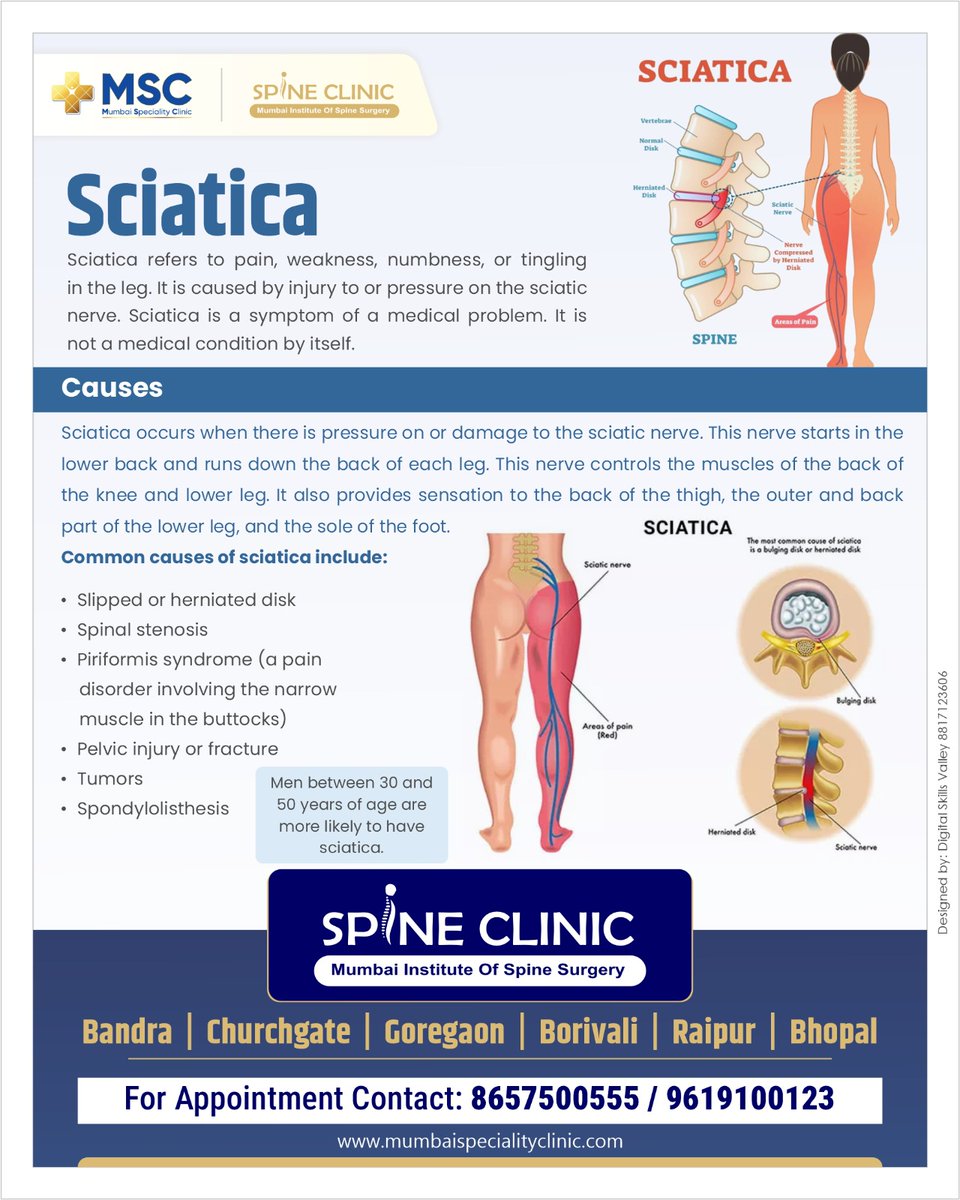 🌟 Say Goodbye to Sciatica Pain ! #SciaticaRelief #PainFreeLiving #ExpertCare #MumbaiSpecialityClinic #Healthcare #Wellness #SciaticaTreatment #SayGoodbyeToPain #PersonalizedCare #QualityHealthcare #BookNow #ConvenientLocations #Bandra #Churchgate #Goregaon #Borivali #Raipur