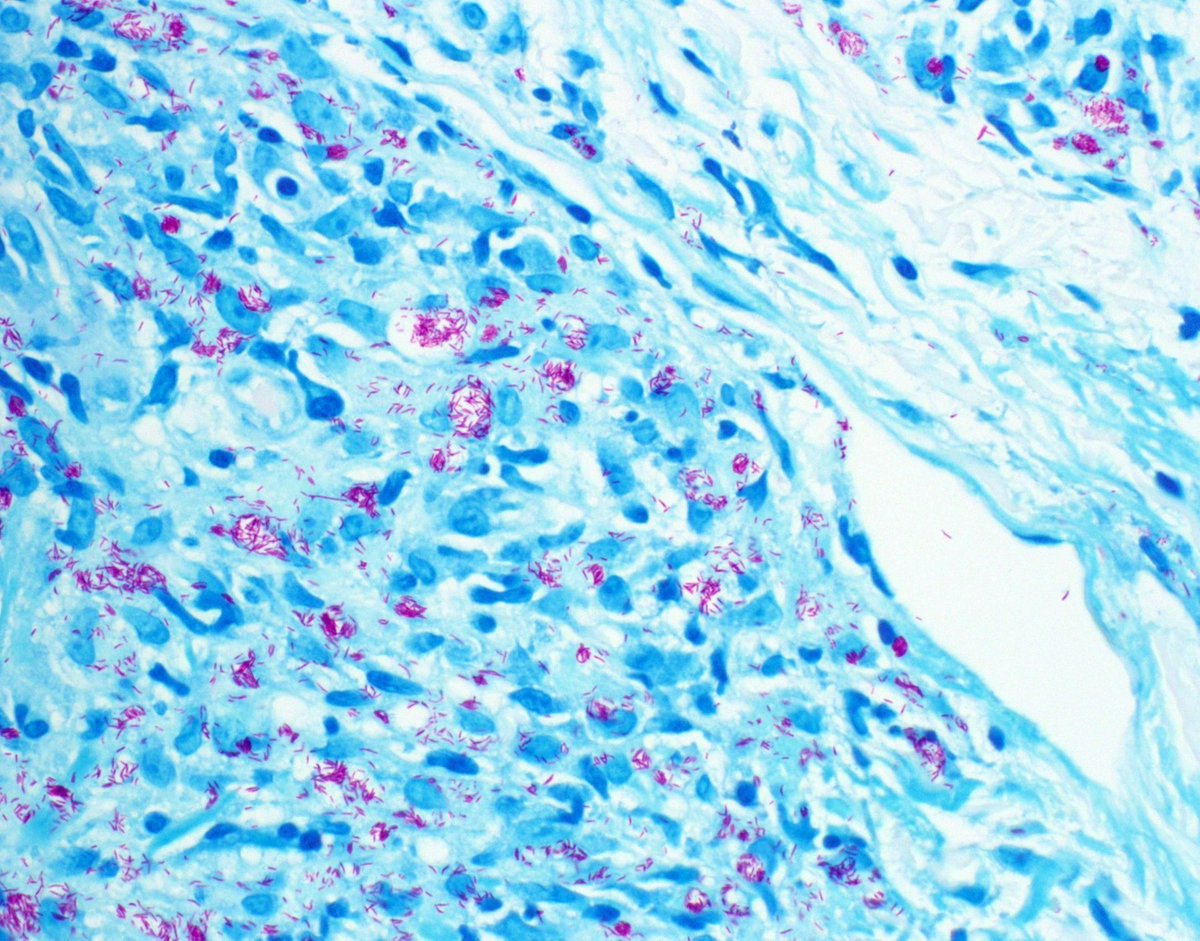 A classic! What stain? What diagnosis? Digital slide: kikoxp.com/posts/2298. More stains: kikoxp.com/posts/10275. Answer: kikoxp.com/posts/2311. How often do you see this in your practice? #pathology #pathologists #pathTwitter #dermpath #dermatology #dermtwitter