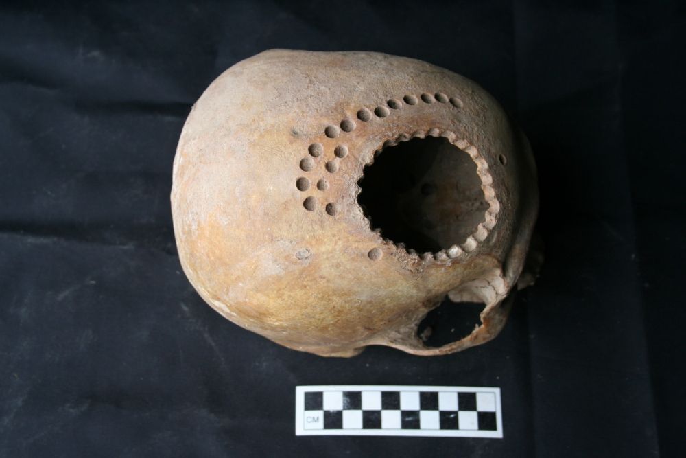 Ancient Neurosurgery:
One of the many skulls found in Peru that have undergone trepanation.
The Inca Empire is believed to be the birthplace of craniotomy.

@AANSNeuro @The_SBNS @neurosurgatlas @TheJNS @neurosurgery @AOSpine

#MedTwitter #MedEd #Neurosurgery #Brain #Spine