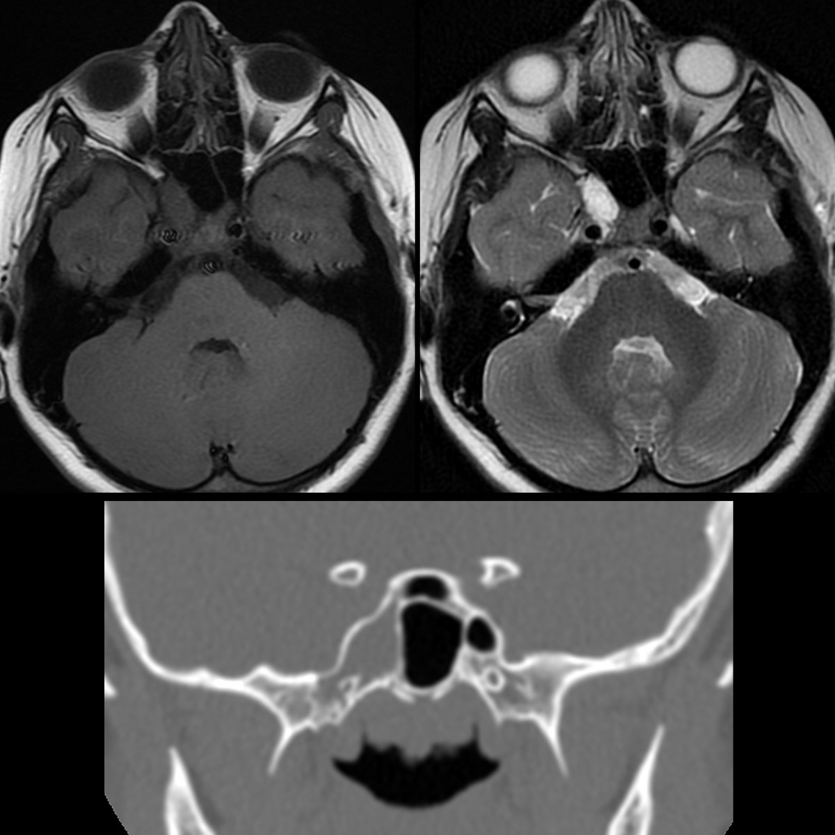 School ager with seizures

Axial T1 MRI without contrast(above left) shows isointense signal intensity lesion in right sphenoid bone that on T2 MRI(above right) shows high signal intensity+which did not show enhancement post contrast. 

#FOAMed #MedEd #FOAMPed #FOAMRad #PedsRad