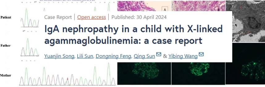 🧬 Inborn Error of Immunity
'the first case of immunoglobulin (Ig) A nephropathy associated with XLA'
bmcpediatr.biomedcentral.com/articles/10.11…