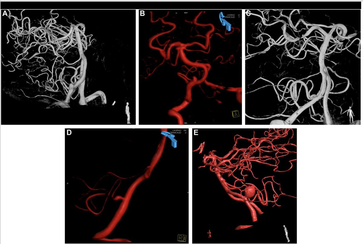 #ONSNew Flow Diversion for the Treatment of Posterior Inferior Cerebellar Aneurysms: A Novel Classification of Posterior Inferior Cerebellar Artery Origin bit.ly/3UFIcNo by Sathya et al @The_BMC @jmascite @LKReedMD @CNS_Update @AliAlawiehmdphd @DKondziolkaCNS