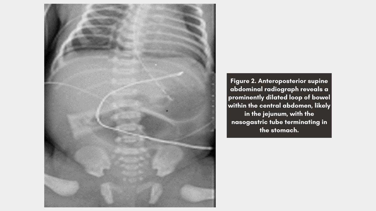 🩻 Case Study of the Week! Post your guess in the comments and check back on Friday to see if your diagnosis was correct! See all the case details, more images, and diagnosis ➡️ bit.ly/3Uo2HN0 #RadEd #Radiology #CaseOfTheWeek #RadRes #CaseStudy #PediatricRadiology