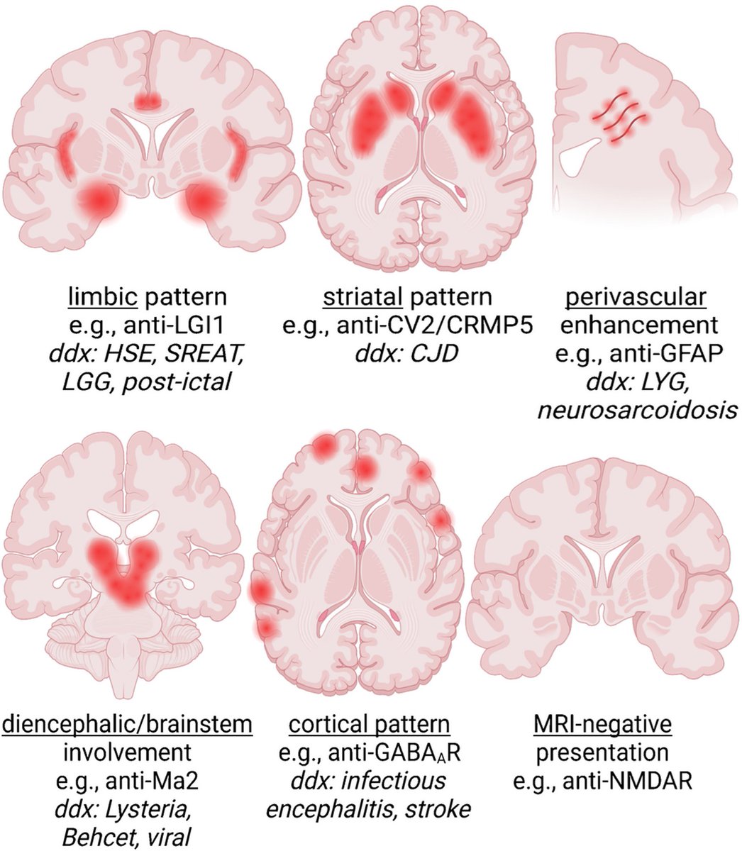 A #TWEETORIAL based on a @radiology_rsna article, A🧵:

1/10

Autoimmune encephalitis (AE) is not rare! one study showed that among persons<30 years old AE was more common than any single infectious cause 🤯 Even HSV-1! Here are some common imaging patterns from @TheAJNR