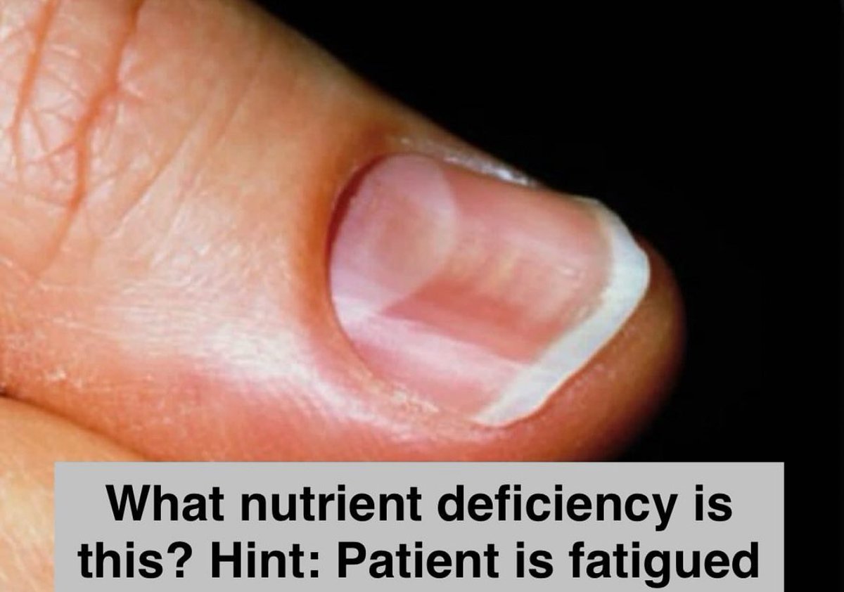 🙋‍♂️ Which nutrient deficiency does this person have? 
#MedEd #FOAMed #Nutrition #Dietitian