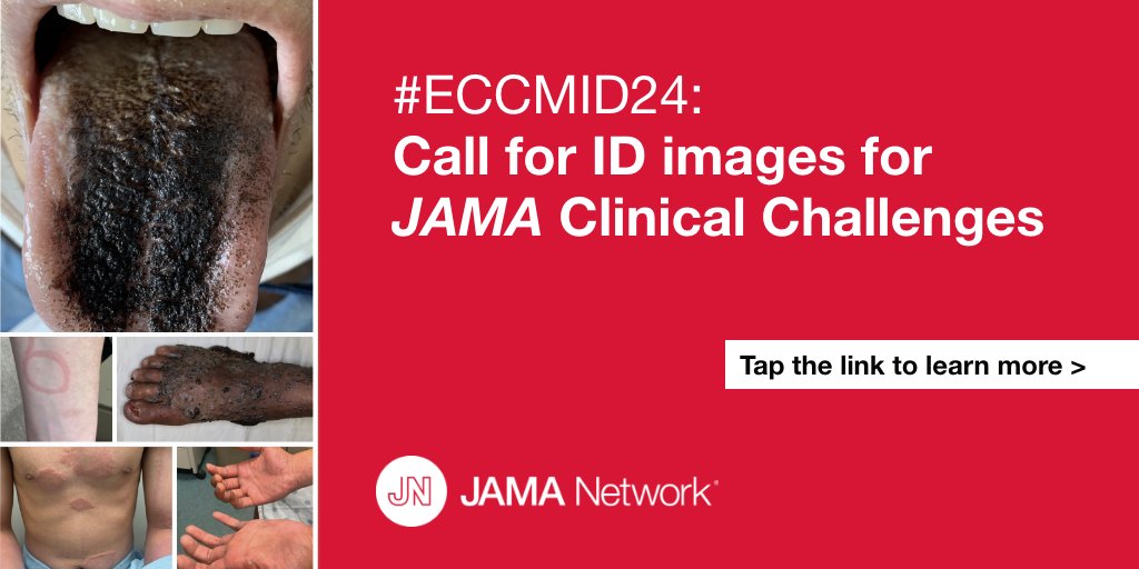 Have you ever considered submitting a JAMA Clinical Challenge? @JAMA_current is accepting submissions for infectious disease patient scenarios. #ECCMID2024 For criteria and information on Clinical Challenge submissions, visit: ja.ma/3UhxIDp