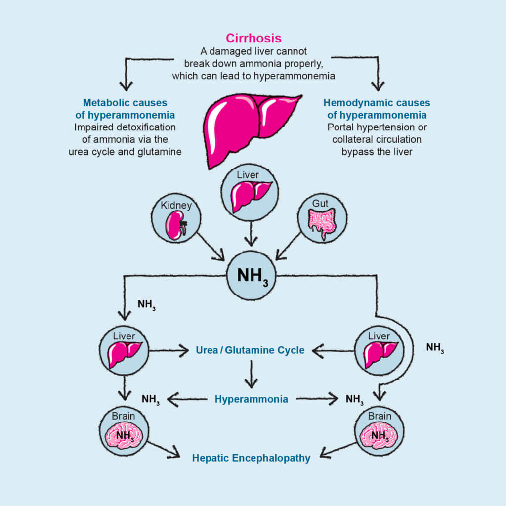 ⚠️ Carbonic anhydrase
inhibitors are
CONTRAINDICATED in HEPATIC 
CIRRHOSIS - ammonium is
not excreted, so serum
ammonia accumulates,
crosses into the brain and
leads to hepatic
encephalopathy.

#MedTwitter #MedEd #MedX #Cirrhosis #diuretics #clinicapearl #encephalopathy