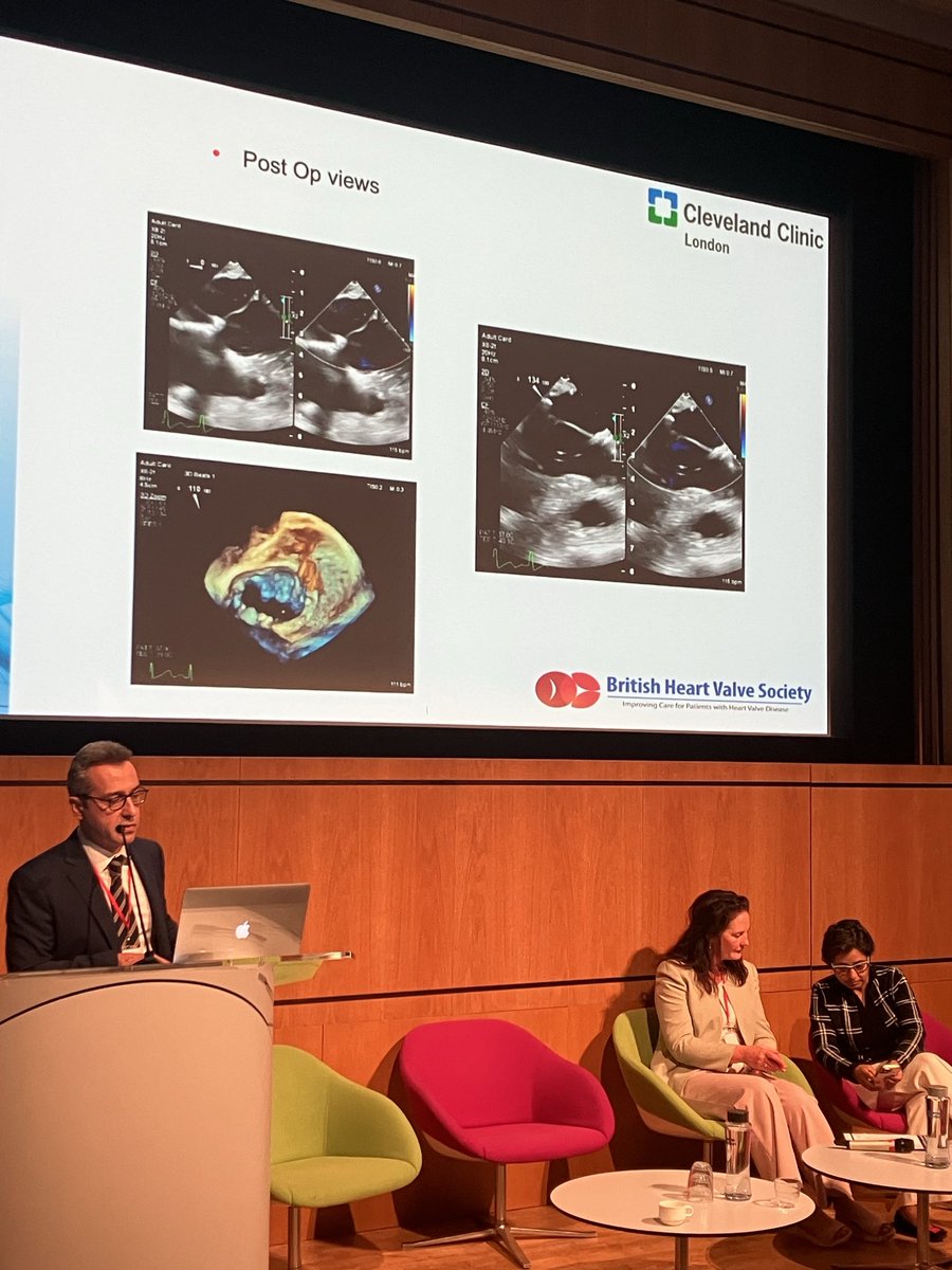 BHVS Spring Meeting - excellent talk including echo assessment to plan mitral valve repair and check result with Max Baghai, minimal invasive mitral surgeon. ⁦@BrHeartValveSoc⁩ ⁦@BISMICS⁩