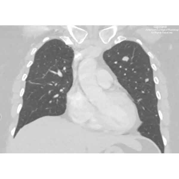 A 43-year-old premenopausal woman undergoing fertility treatment presents with the chief complaint of shortness of breath. #ACRCaseinPoint bit.ly/3WyGzm3