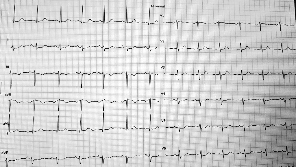 OMI?

@DrRazi4 @The_Nanashi_O @ecgrhythms @DidlakeDW 

#Cardiology #cardiovascular #MedTwitter #ECG #EKG #cardiologist #STEMI #OMI #paramedics #cathlab #QueenOfHeart