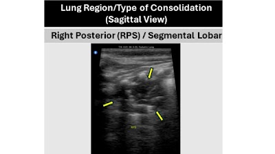 Curated Dataset of Lung US Images of Zambian Children with Clinical Pneumonia Containing Annotations for Consolidation Patterns doi.org/10.1148/ryai.2… @BUSPH @The_BMC @MCG_AUG #PedsRad #POCUS #ML