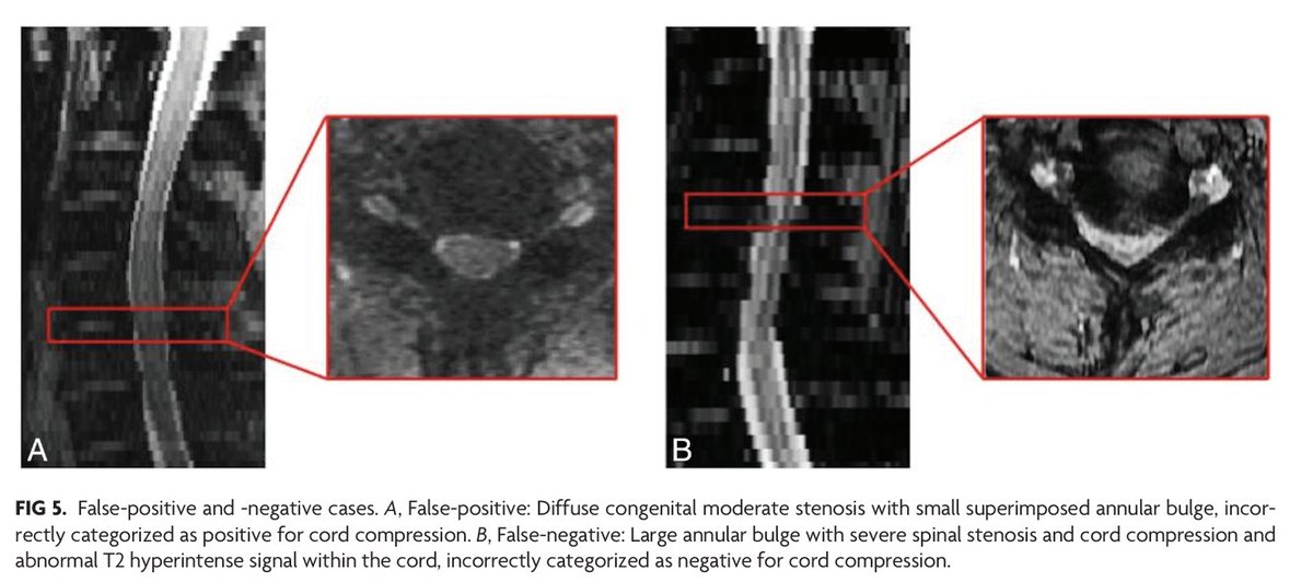 'Automated Detection of Cervical Spinal Stenosis and Cord Compression via Vision Transformer and Rules-Based Classification' doi.org/10.3174/ajnr.A… @DavidLPayneMD @The_ASSR