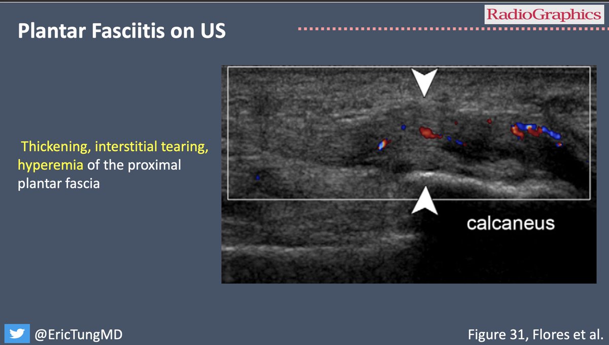 US is valuable for assessment of the plantar fascia as well! Fascial thickening, interstitial tearing, and hyperemia are sonographic features of plantar fasciitis.

#RGphx @RadG_Editor #MSKrad
8/9