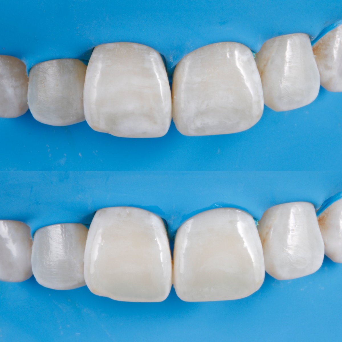 Caso de Odontología de mínima invasión ✨ 
ICON, resina infiltrante para manchas de hipomineralización en los dos centrales en tercio incisal 👌🏻✅

#sonrisa #dientessanos #odontologianoinvasiva #ICON #resinainfiltrante